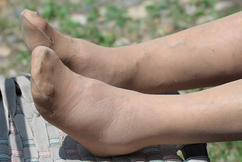 donna con piedi gonfi