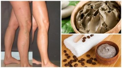 5 soluzioni naturali per combattere con successo le vene varicose