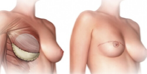 Cosa sapere sulla mastectomia Cosa sapere sulla mastectomia
