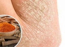 Psoriasi di akriderm di una parte pelosa della testa