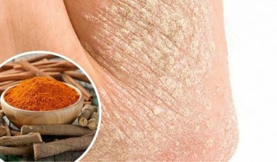 Curare la psoriasi in modo naturale