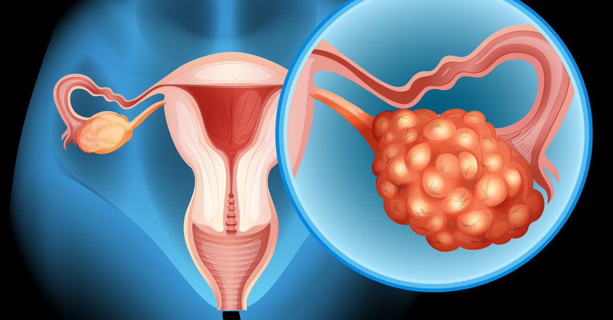 Cosa sapere prima di farsi asportare