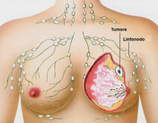 Combattere il cancro al seno con i probiotici