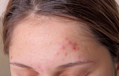 Sovraccarico di tossine: 9 sintomi