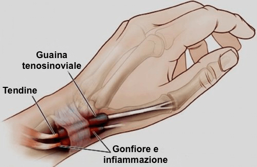 Tenosinovite: l’infiammazione delle mani o dei piedi