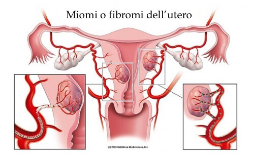 Fibroma uterino: 5 cose che bisogna sapere