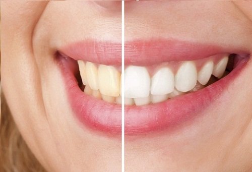 sbiancare-i-denti
