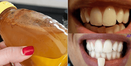 Come sbiancare i denti con l’aceto di mele