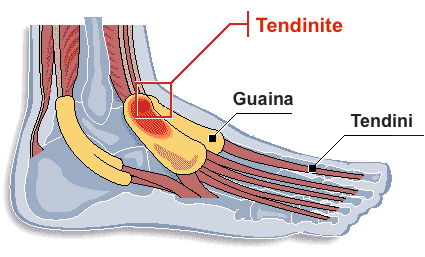 La tenosinovite è un’infiammazione del rivestimento della guaina che circonda il tendine