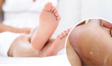 Eliminare i calli ai piedi con trattamenti naturali