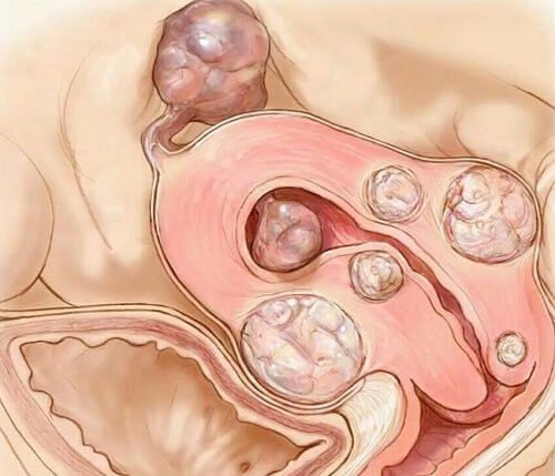 Fibroma uterino