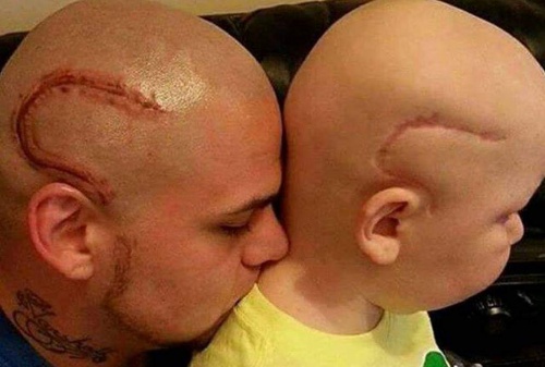 “Ora siamo uguali”: padre si fa tatuare la cicatrice del figlio, operato di cancro