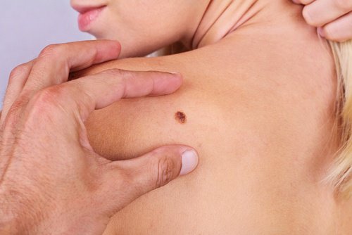 Cancro della pelle: 7 cose che non forse non sapete