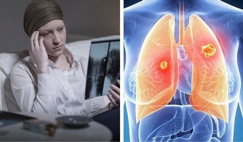 Il cancro ai polmoni colpisce soprattutto le donne
