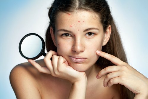 ragazza con acne