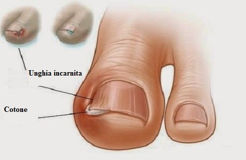 Unghia incarnita? Ecco 6 rimedi naturali ideali