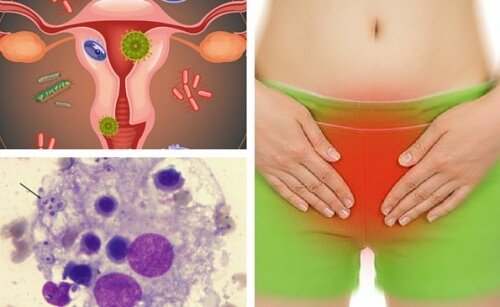 Infezioni vaginali da funghi: 7 consigli per combatterle