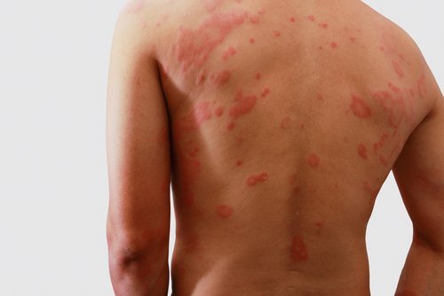 Herpes Zoster