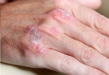 Malattie autoimmuni: 5 segni da non trascurare