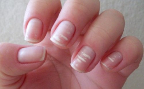 Unghie femminili con macchie bianche