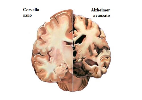 alzheimer-cervello