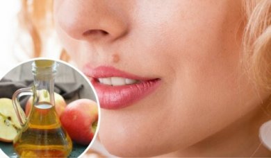 Come eliminare i nei in modo naturale