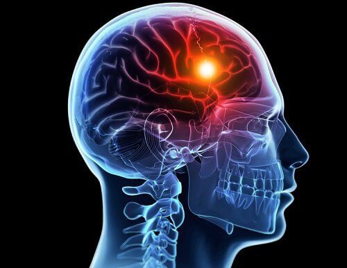 Infarto cerebrale: riconoscerlo grazie a 8 segnali del corpo