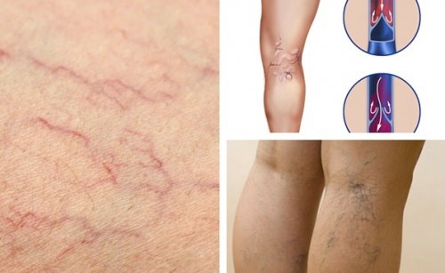 Gambe con vene varicose e capillari visibili