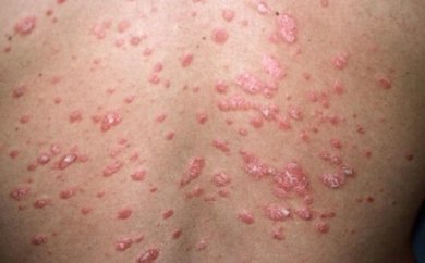 Scopriamo le diverse forme di psoriasi