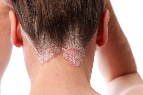 psoriasi guttata sulla nuca