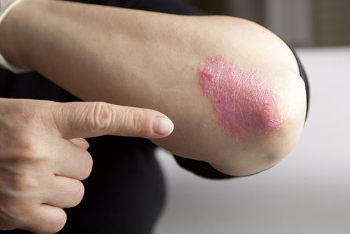 psoriasi placca