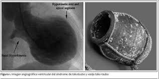 sindrome cuore infranto