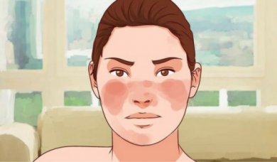 Lupus: 7 rimedi per questa malattia autoimmune