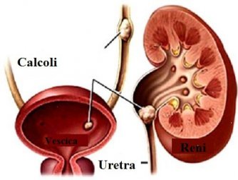 6 alimenti che possono provocare i calcoli renali