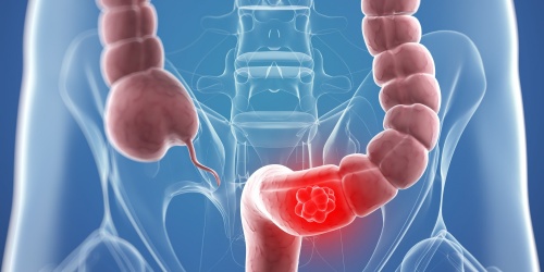 9 rimedi naturali per trattare il tumore al colon