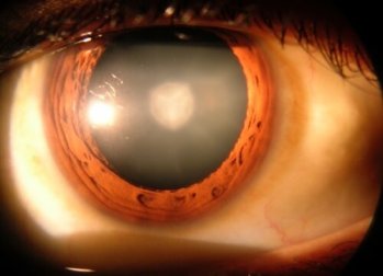 8 dati da conoscere sulle cataratte