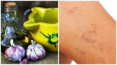Trattamento all'aglio e olio d'oliva contro le varici
