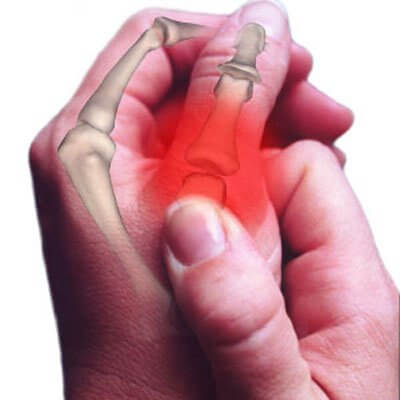 Artrosi al dito
