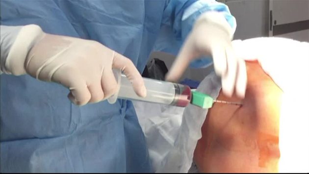 intervento-donazione-midollo-osseo