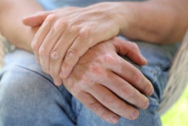Vitiligine: 9 rimedi naturali per curarla
