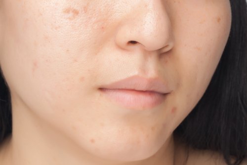 7 abitudini alimentari che danneggiano il viso 7 abitudini alimentari che danneggiano il viso