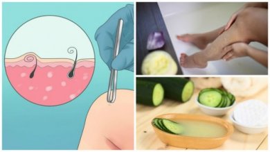 5 soluzioni naturali per rimuovere i peli incarniti