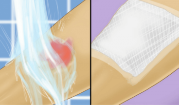 Ustioni da acqua bollente e primo soccorso