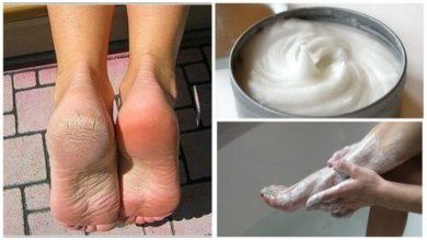Rimedio naturale per eliminare funghi e calli dai piedi