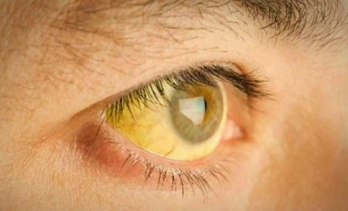 occhi gialli a causa di un eccesso di tossine nel corpo