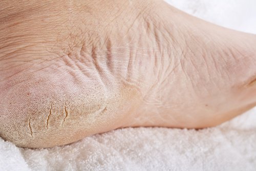 Eliminare calli e funghi dai piedi si può, con aspirina e limone