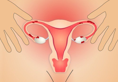 endometriosi