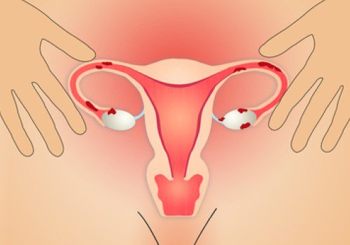 Endometriosi: 5 aspetti per migliorare la qualità della vita Endometriosi: 5 aspetti per migliorare la qualità della vita