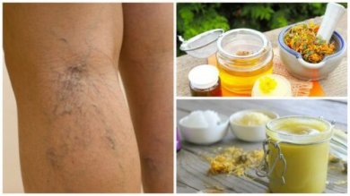 Arnica per le vene varicose: una pomata preziosa
