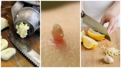 Liberarsi delle verruche col rimedio dell'aglio e limone